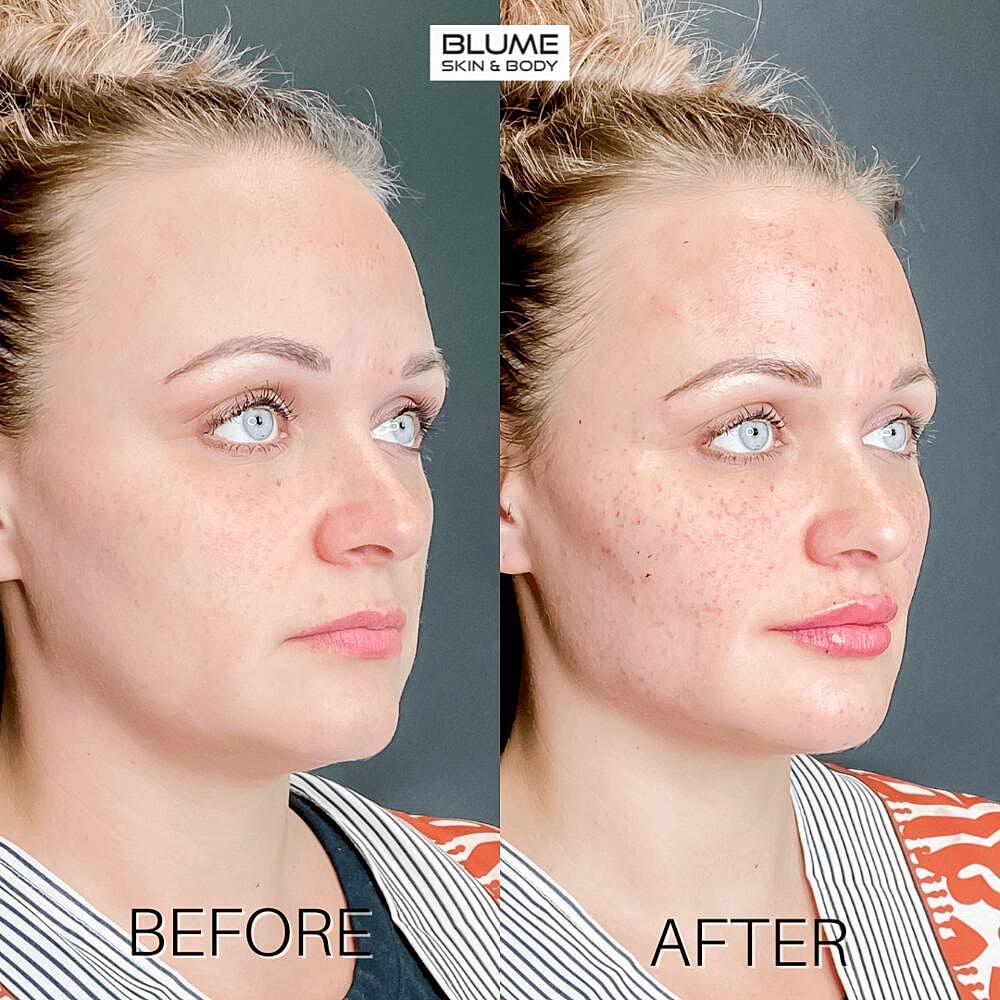 Dermal Fillers Before & After