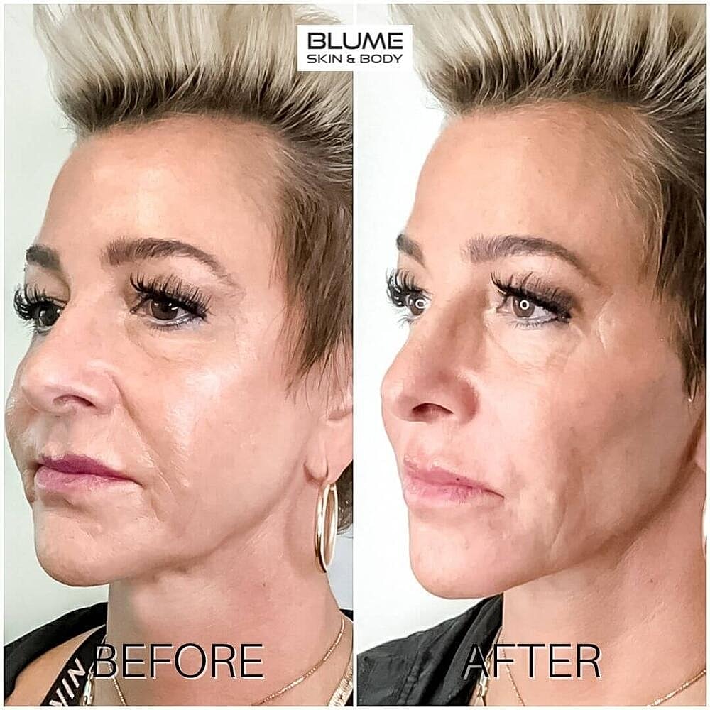 Dermal Fillers Before & After