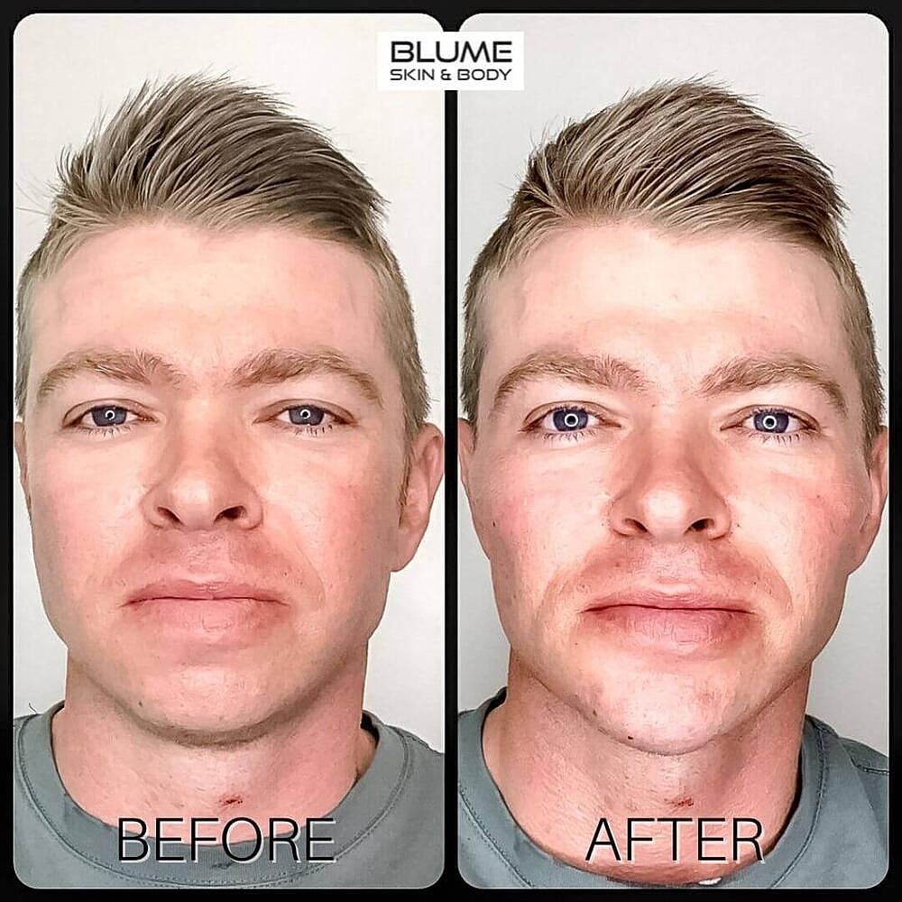 Dermal Fillers Before & After