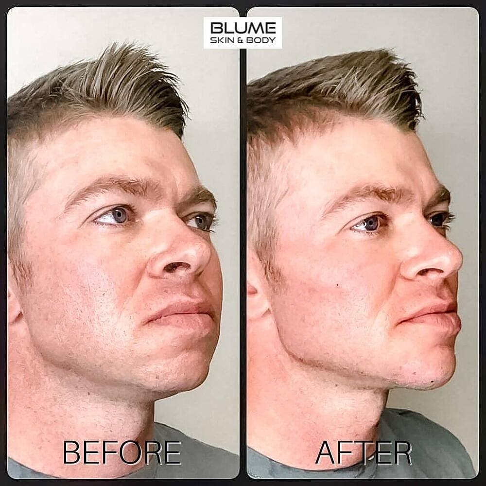 Dermal Fillers Before & After