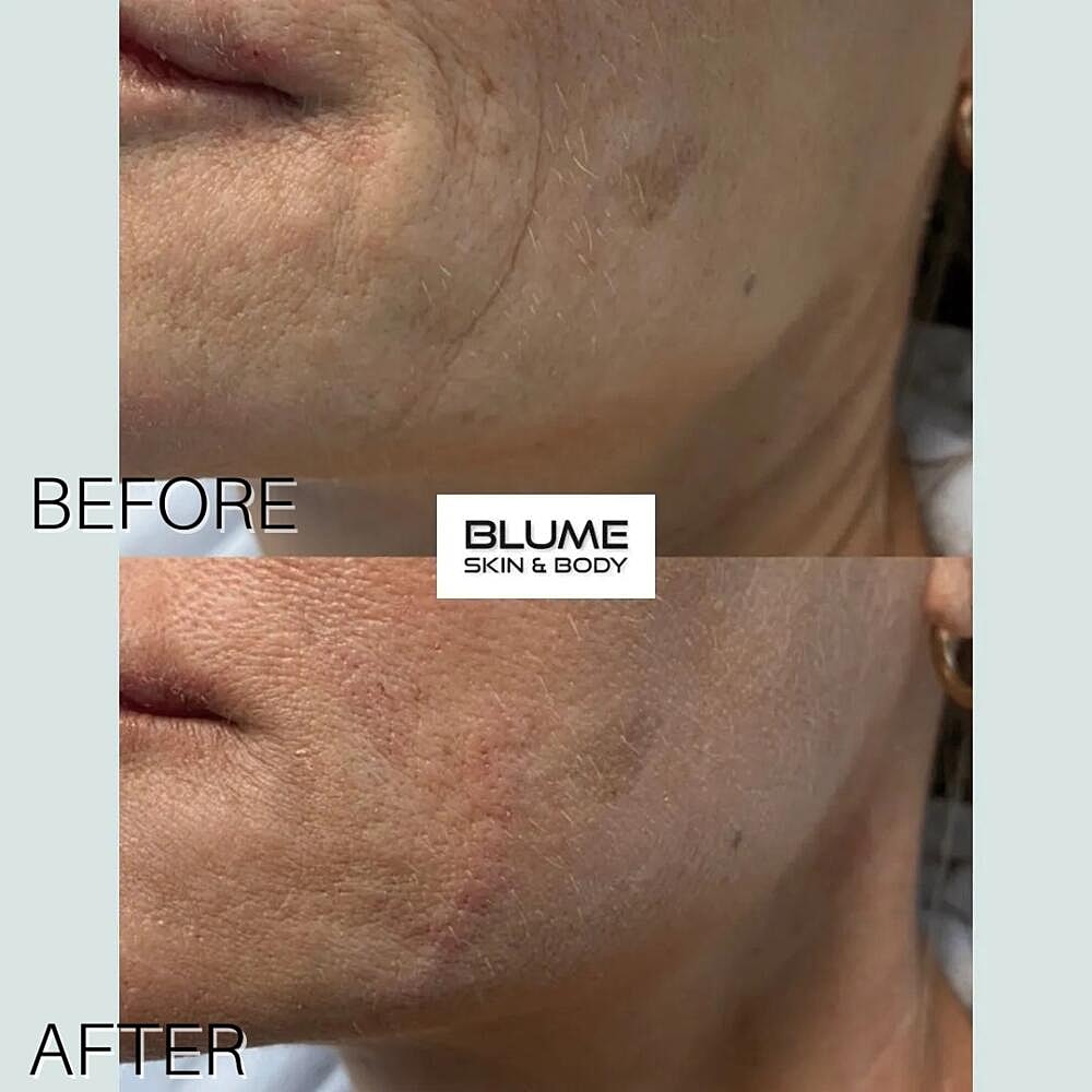 Dermal Fillers Before & After