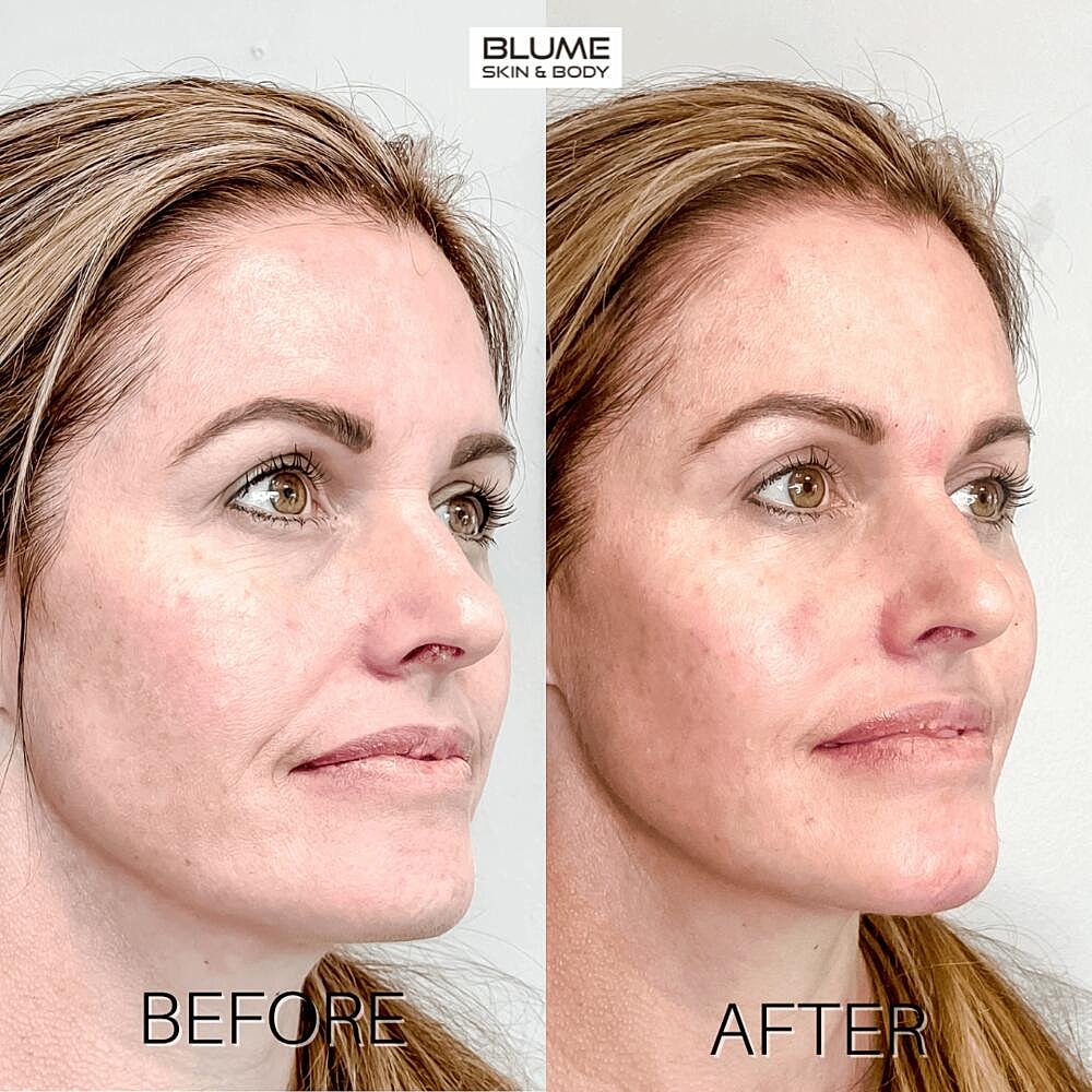 Dermal Fillers Before & After