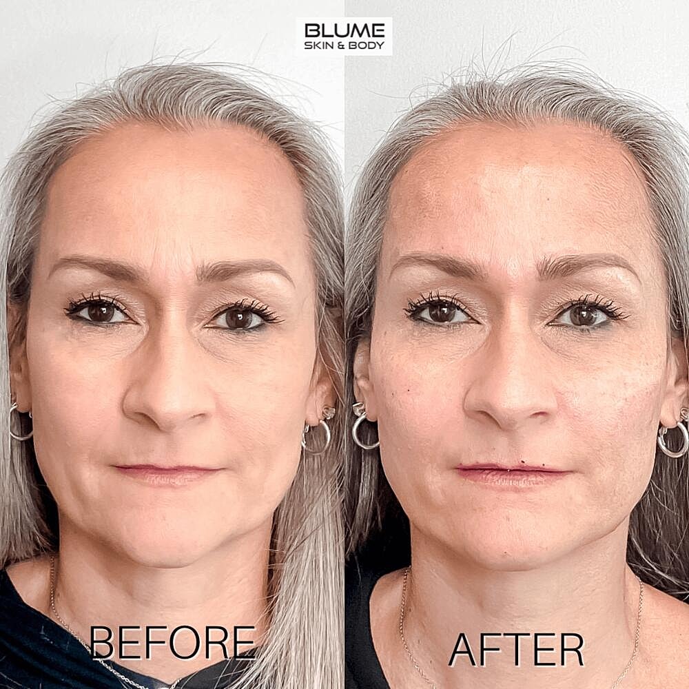 Dermal Fillers Before & After