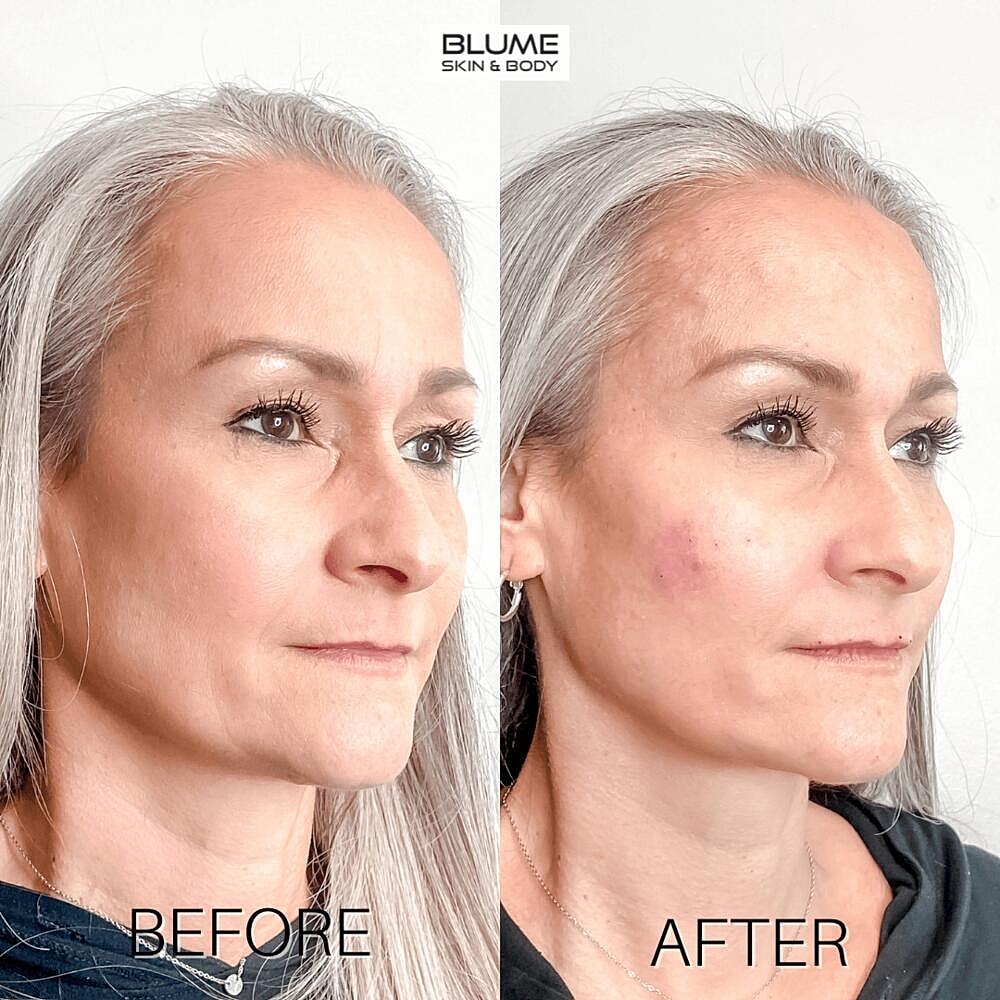 Dermal Fillers Before & After