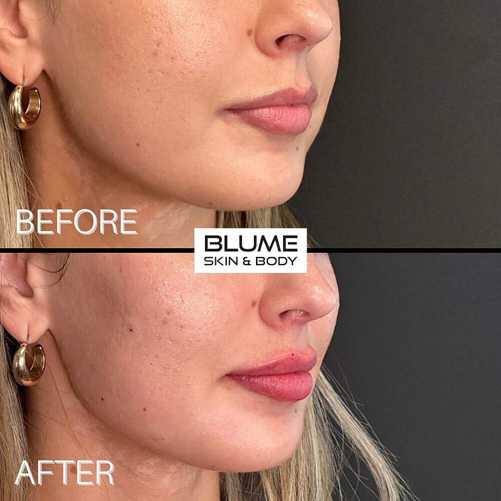 Dermal Fillers Before & After
