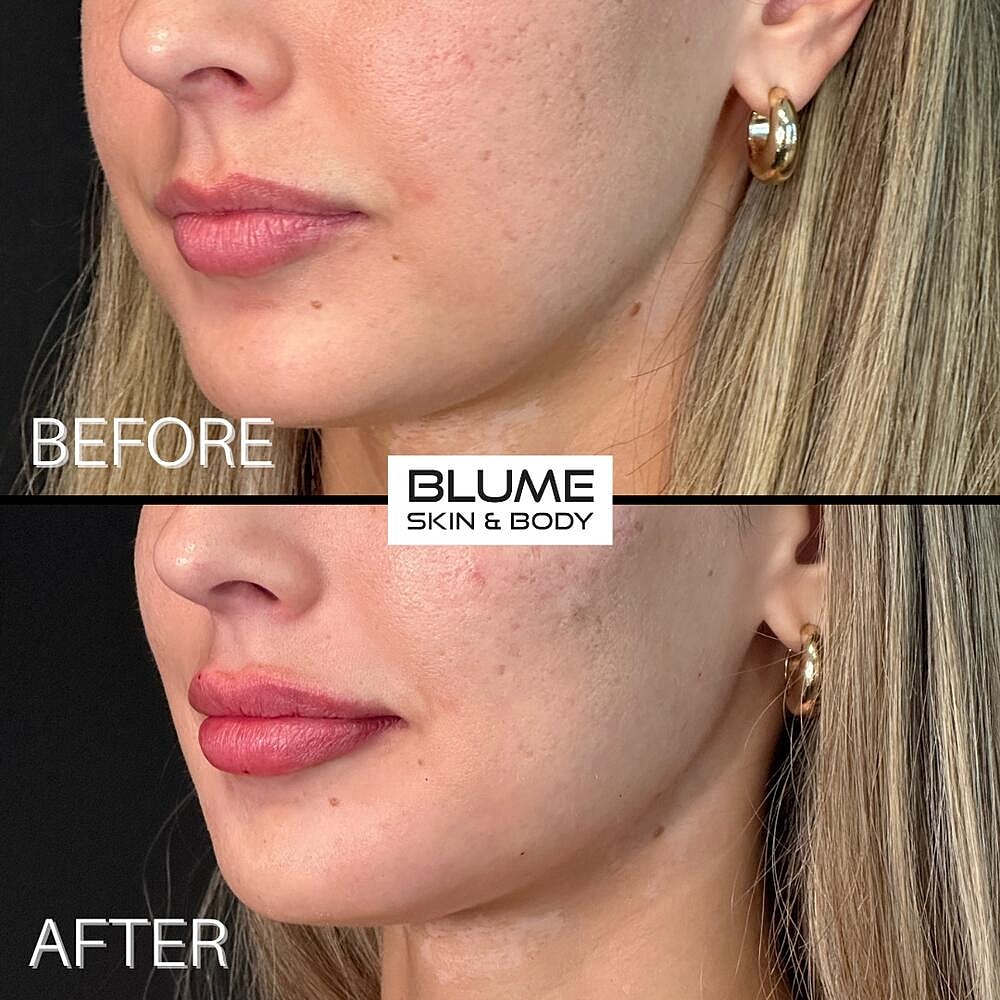 Dermal Fillers Before & After