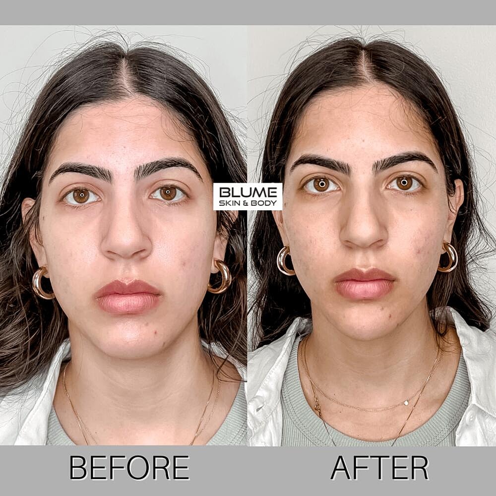 Dermal Fillers Before & After