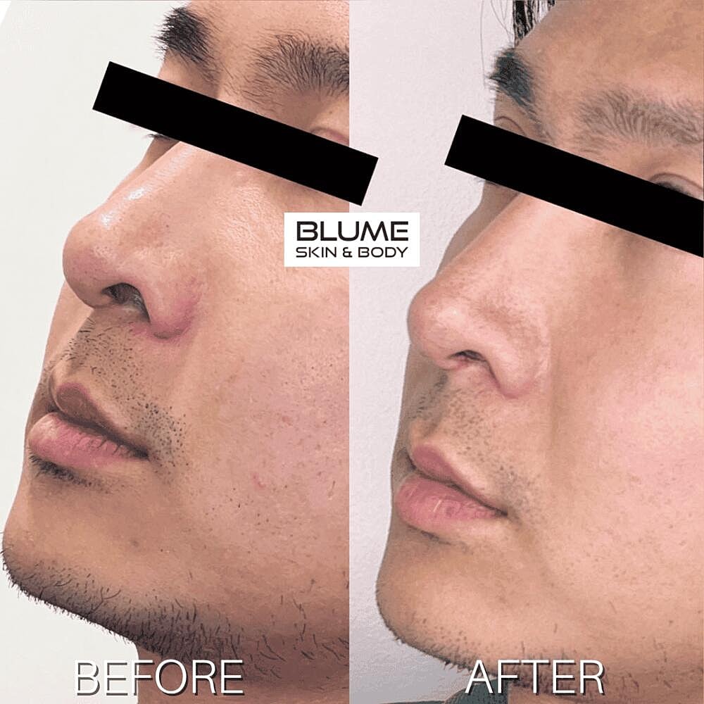 Dermal Fillers Before & After