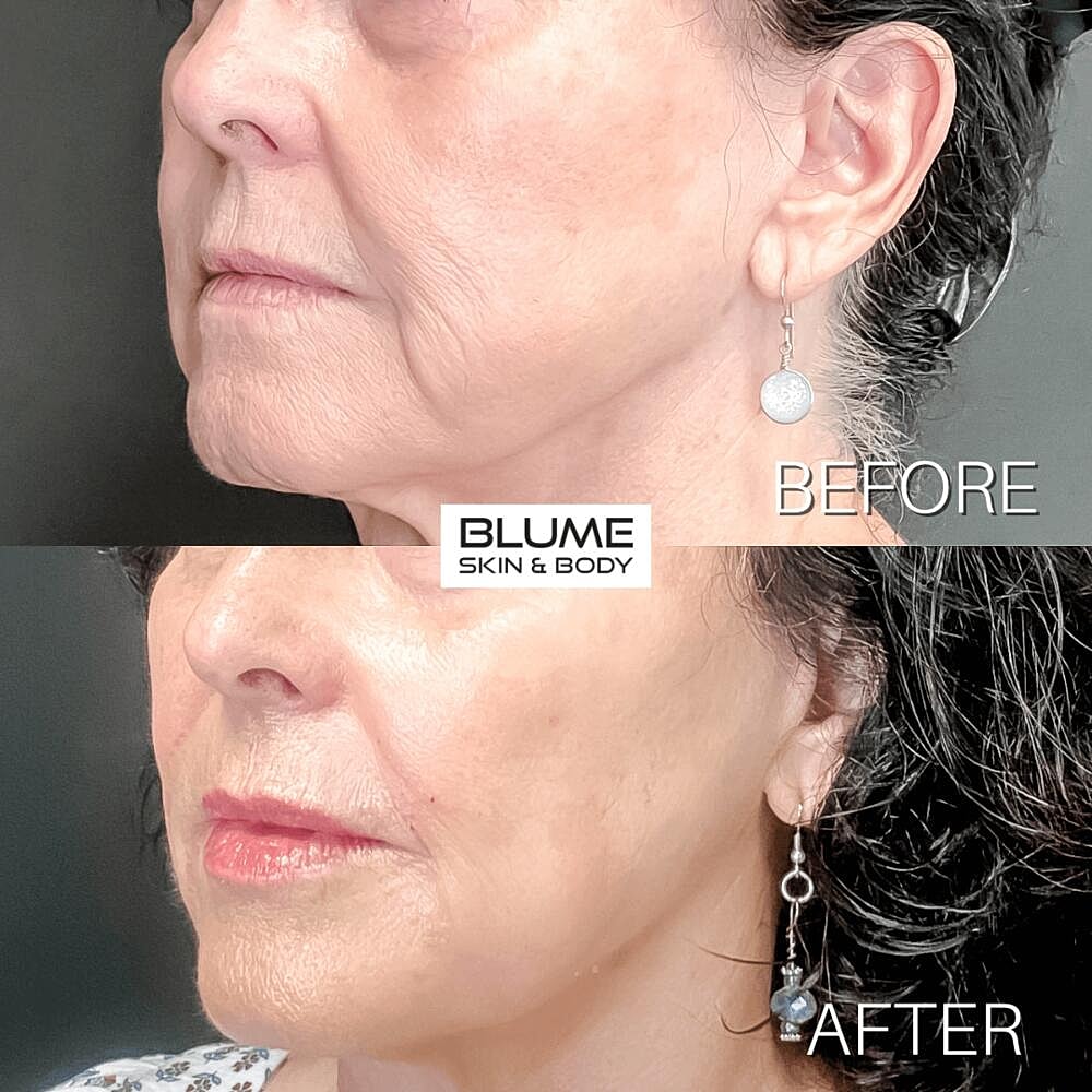 Dermal Fillers Before & After