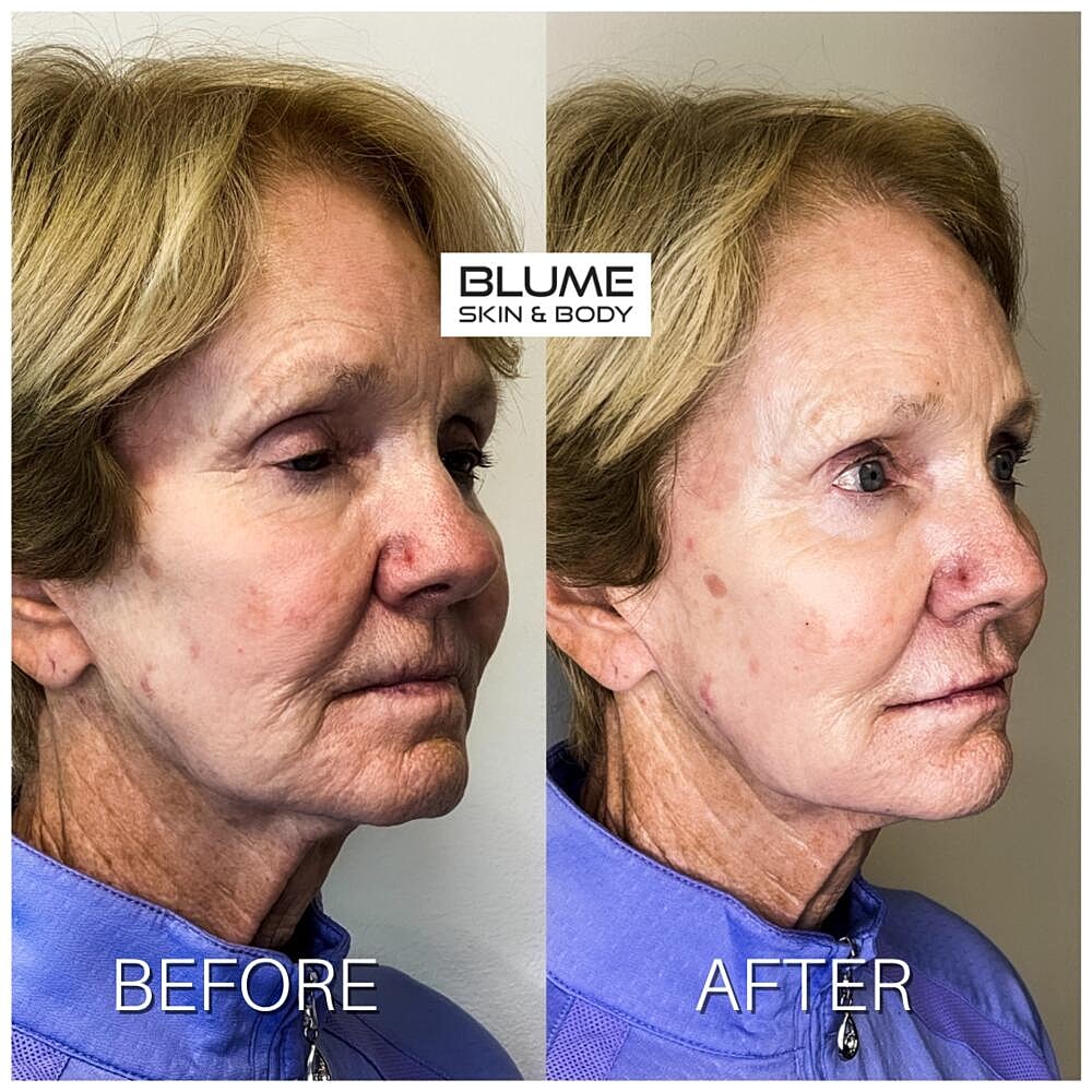 Dermal Fillers Before & After