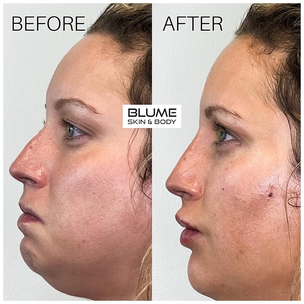 Dermal Fillers Before & After