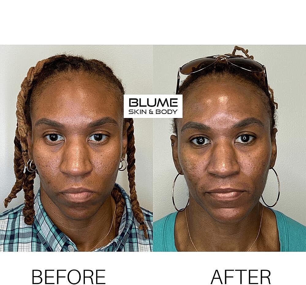 Dermal Fillers Before & After