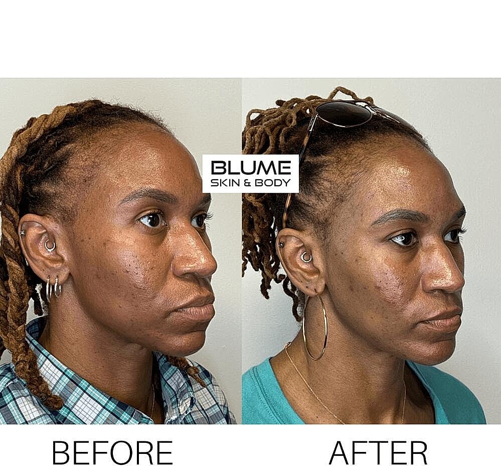 Dermal Fillers Before & After