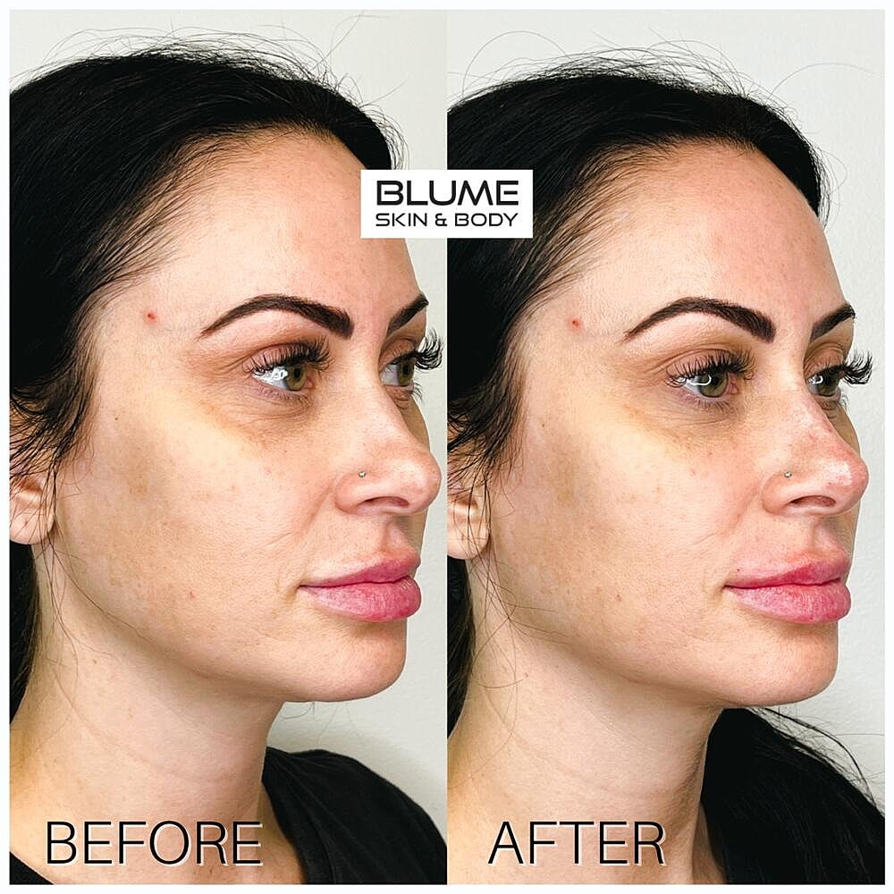 Dermal Fillers Before & After