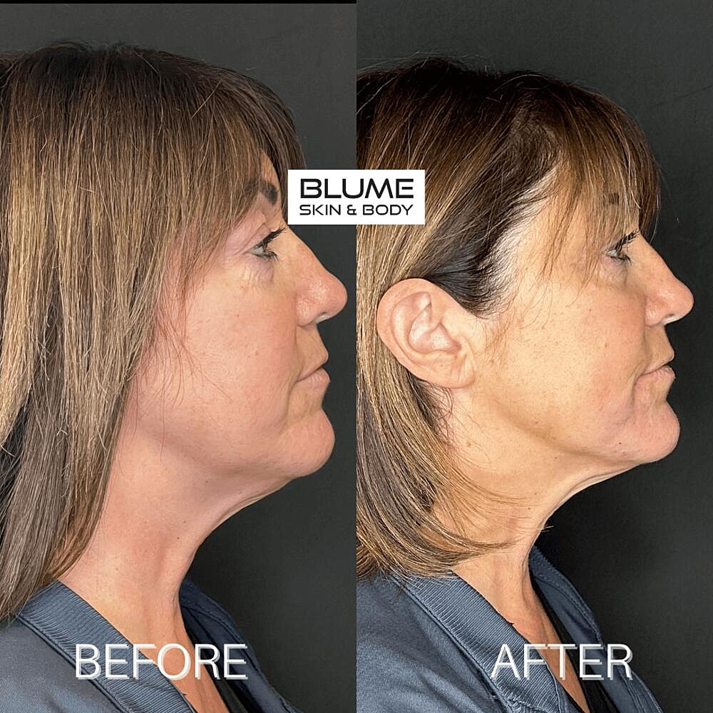 Dermal Fillers Before & After