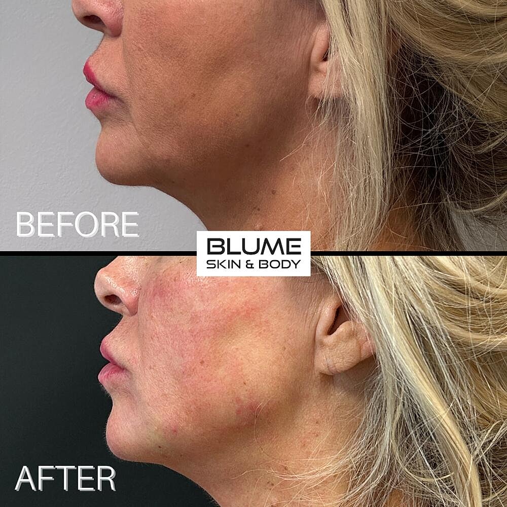 Dermal Fillers Before & After