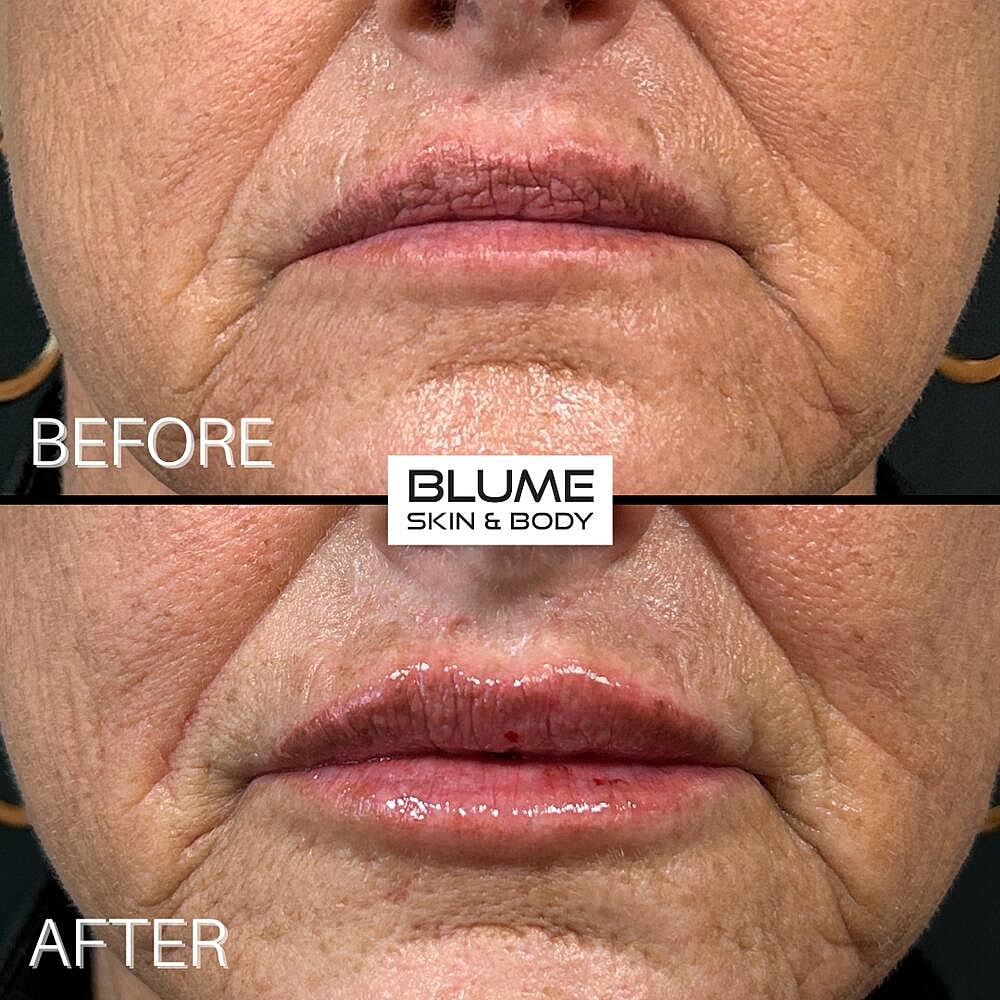 Dermal Fillers Before & After