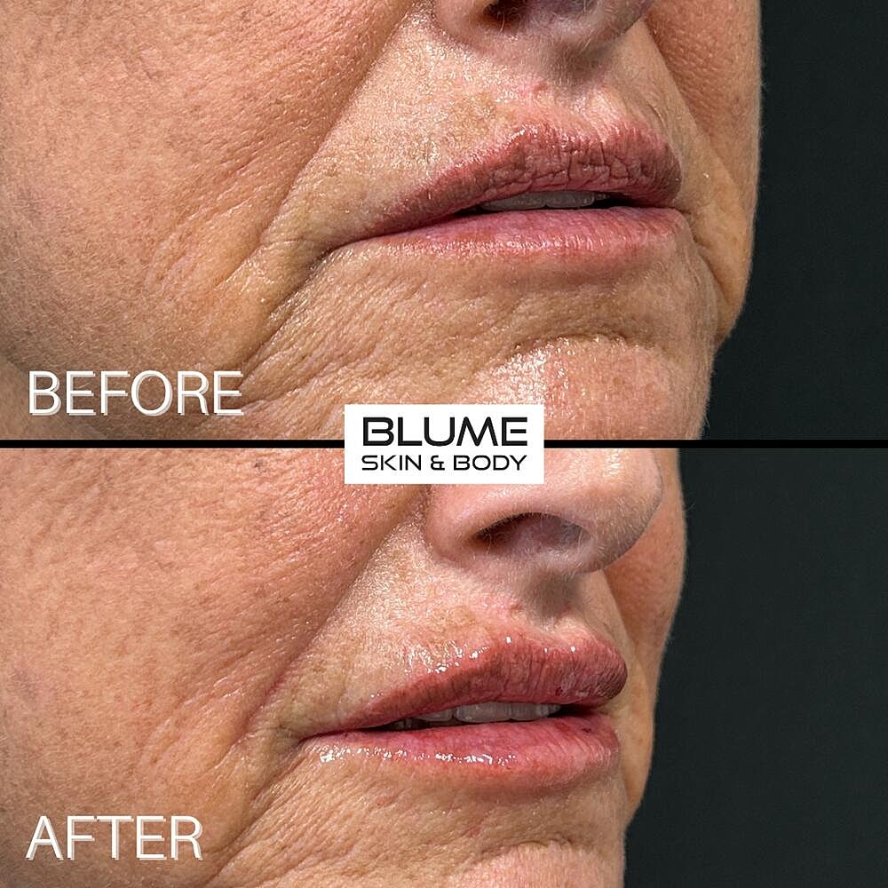 Dermal Fillers Before & After