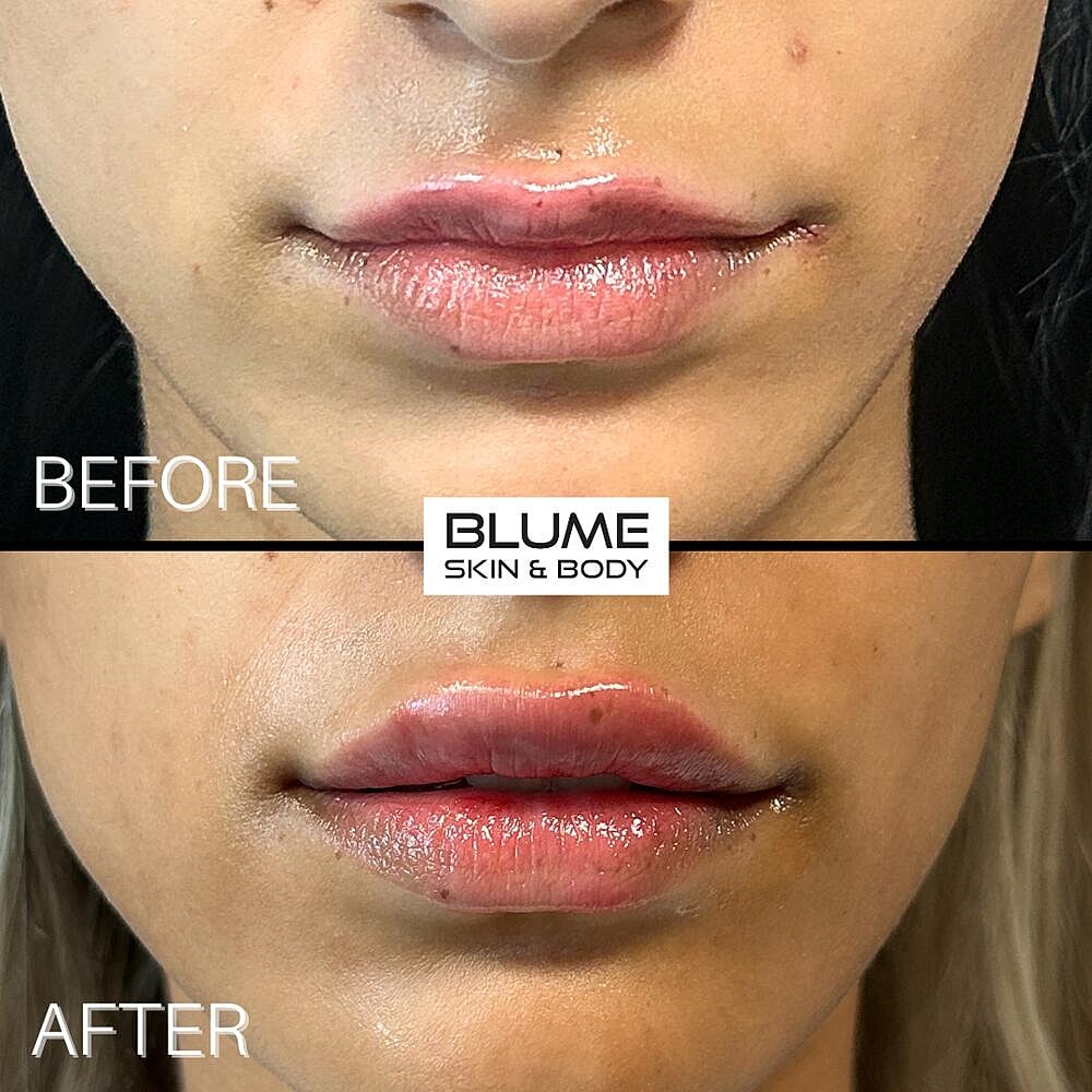 Dermal Fillers Before & After