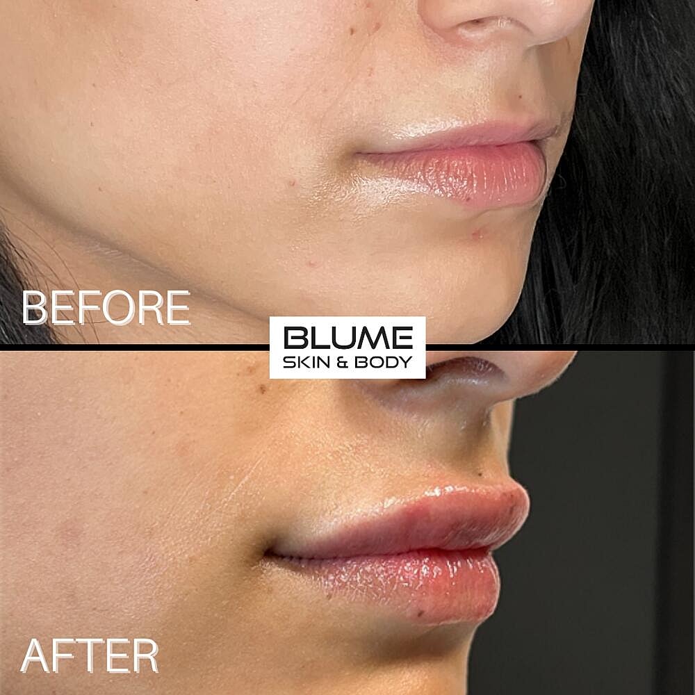 Dermal Fillers Before & After