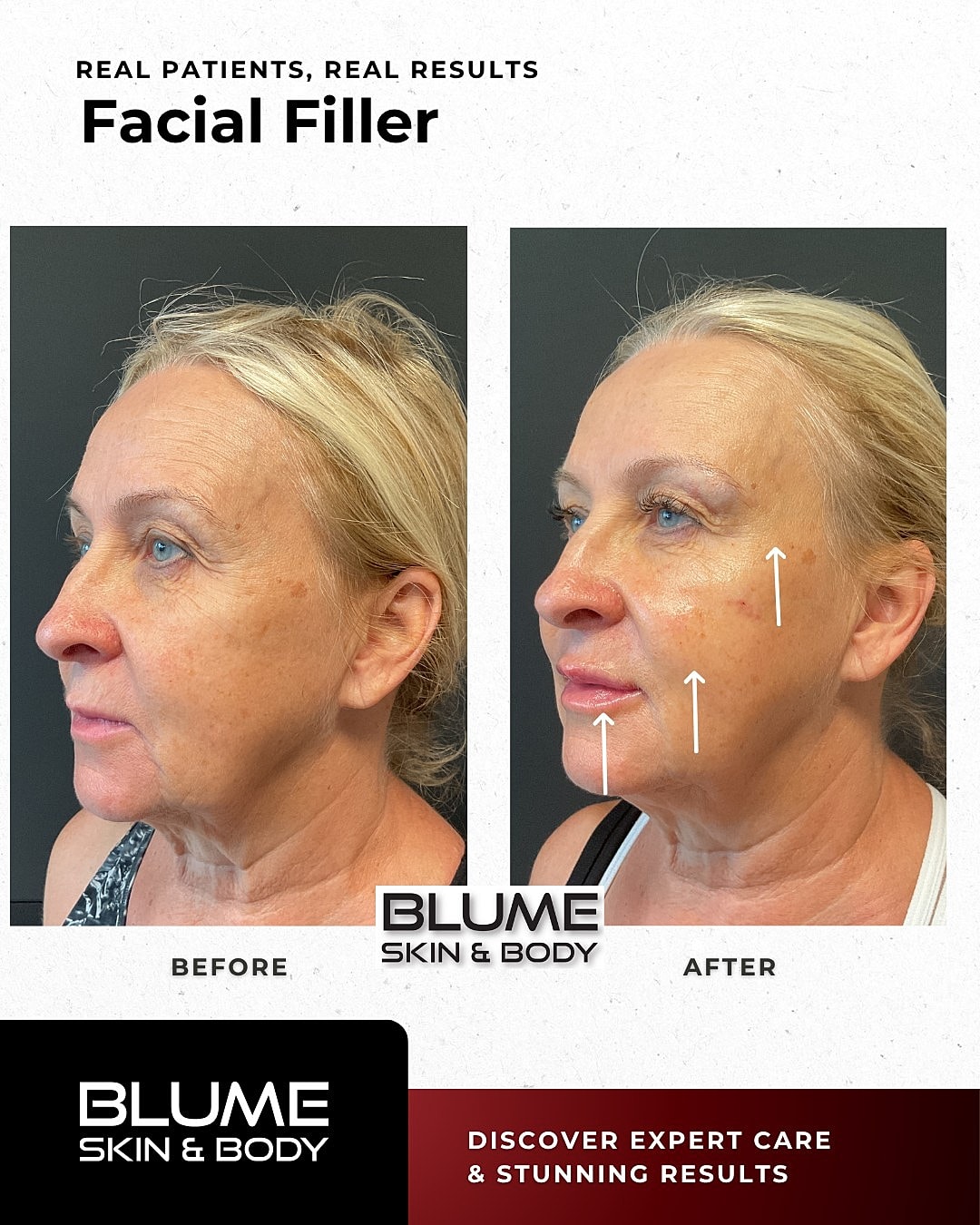 Before and after facial filler treatment comparison