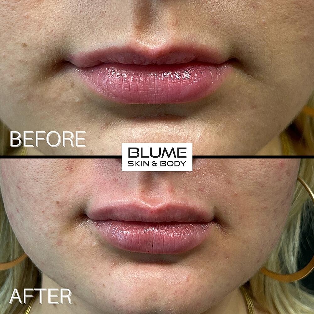 Dermal Fillers Before & After