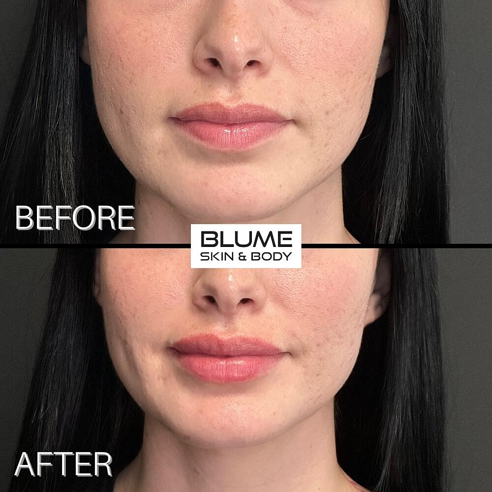 Dermal Fillers Before & After