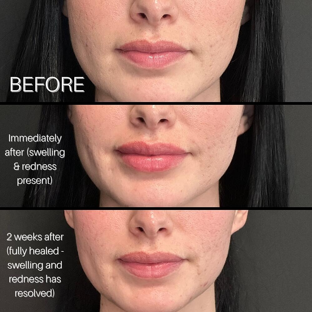 Dermal Fillers Before & After