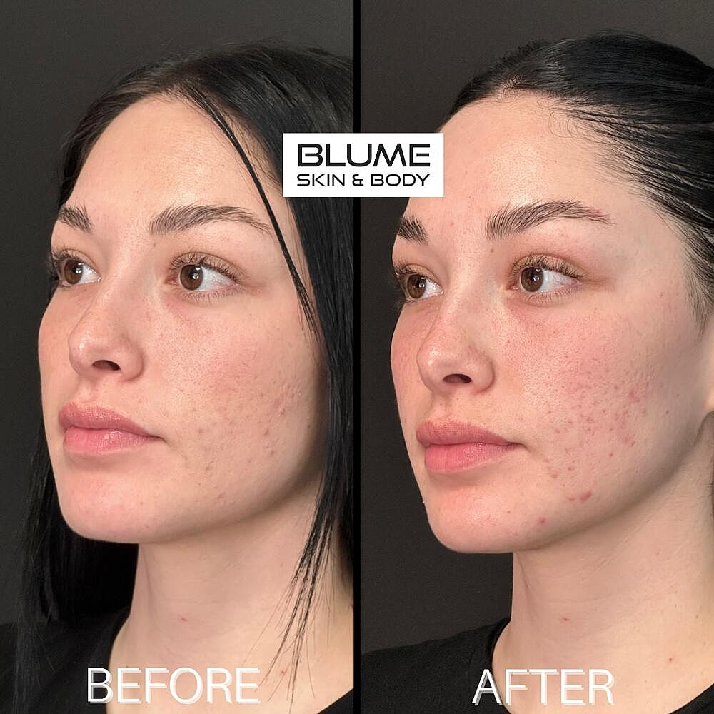 Dermal Fillers Before & After