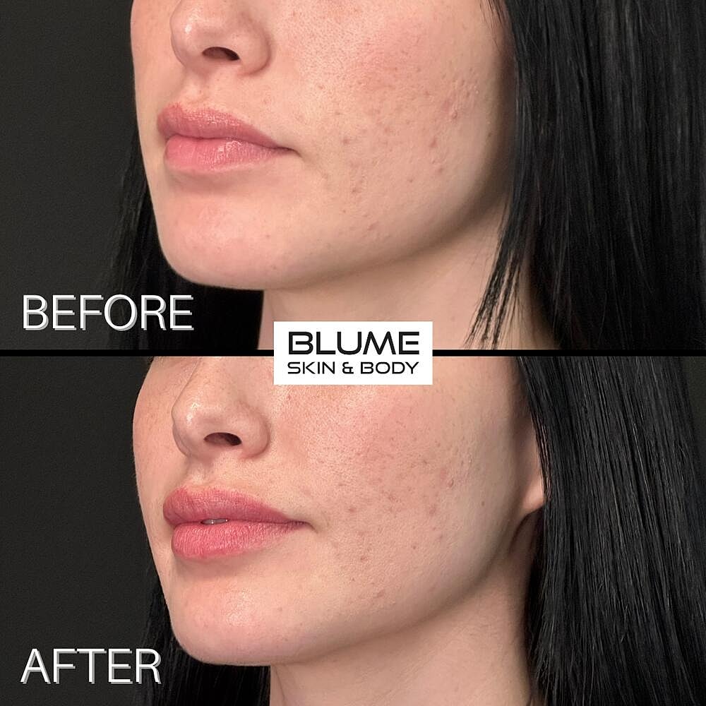 Dermal Fillers Before & After
