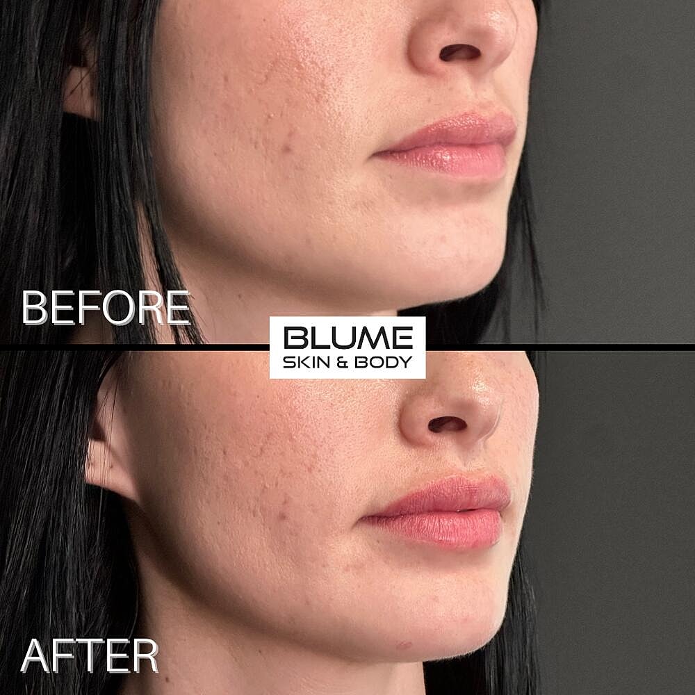 Dermal Fillers Before & After