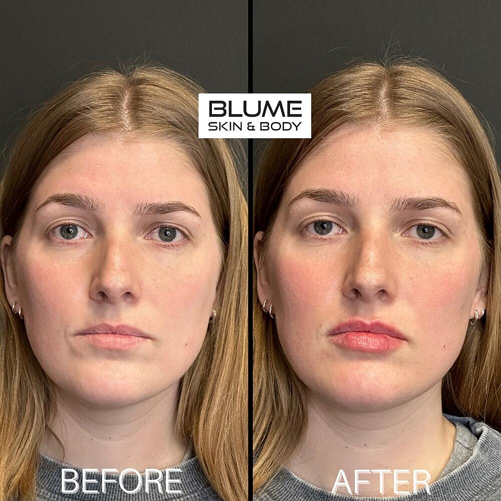 Dermal Fillers Before & After