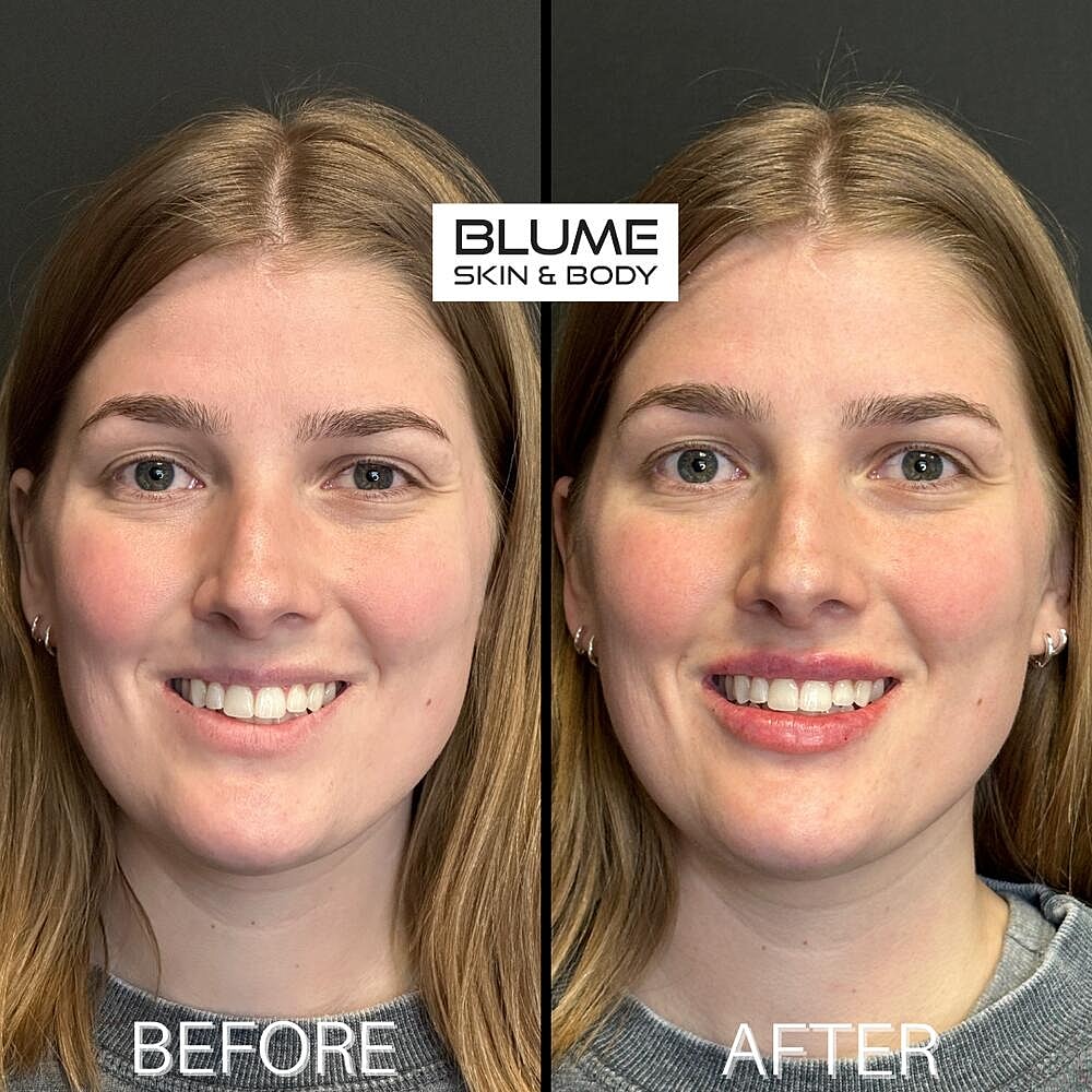 Dermal Fillers Before & After