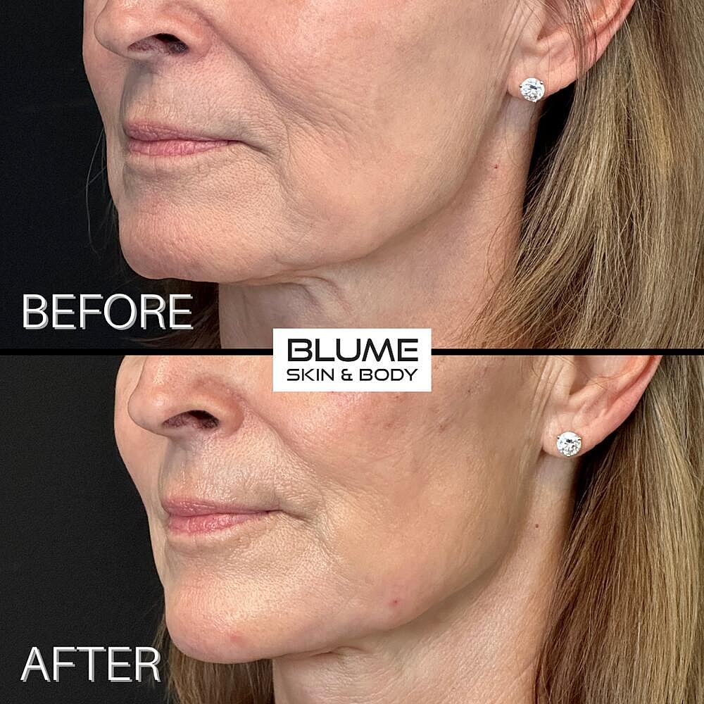 Dermal Fillers Before & After