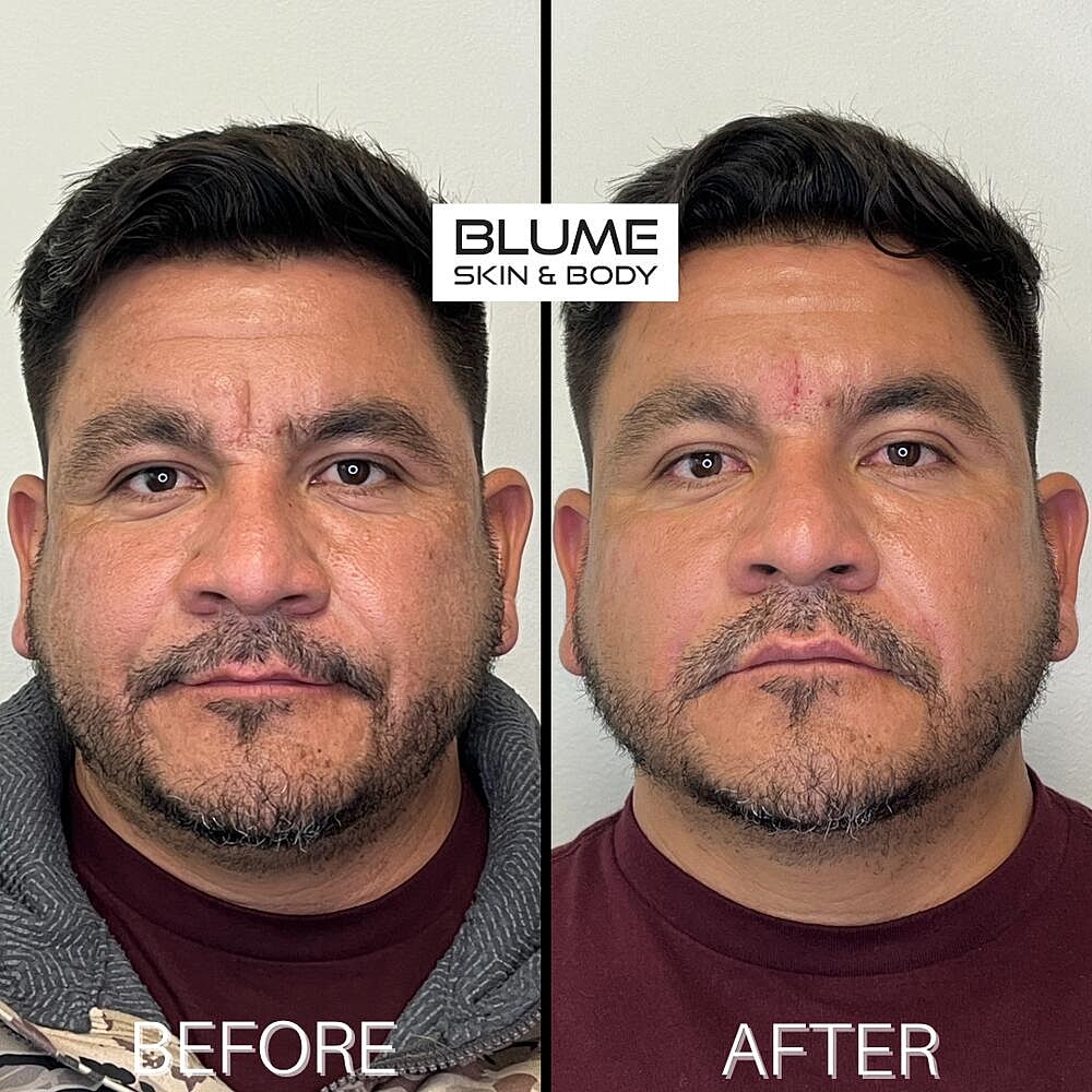 Dermal Fillers Before & After