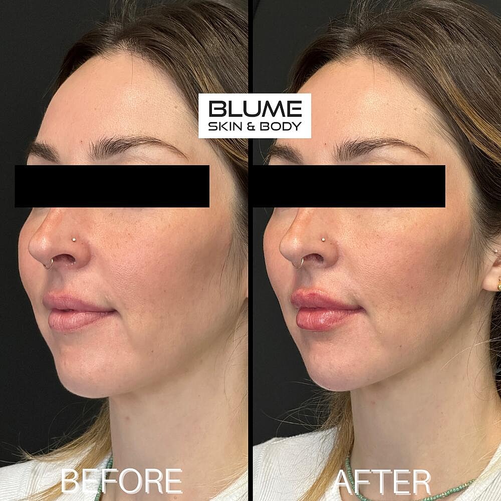 Dermal Fillers Before & After
