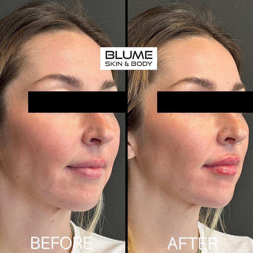 Dermal Fillers Before & After