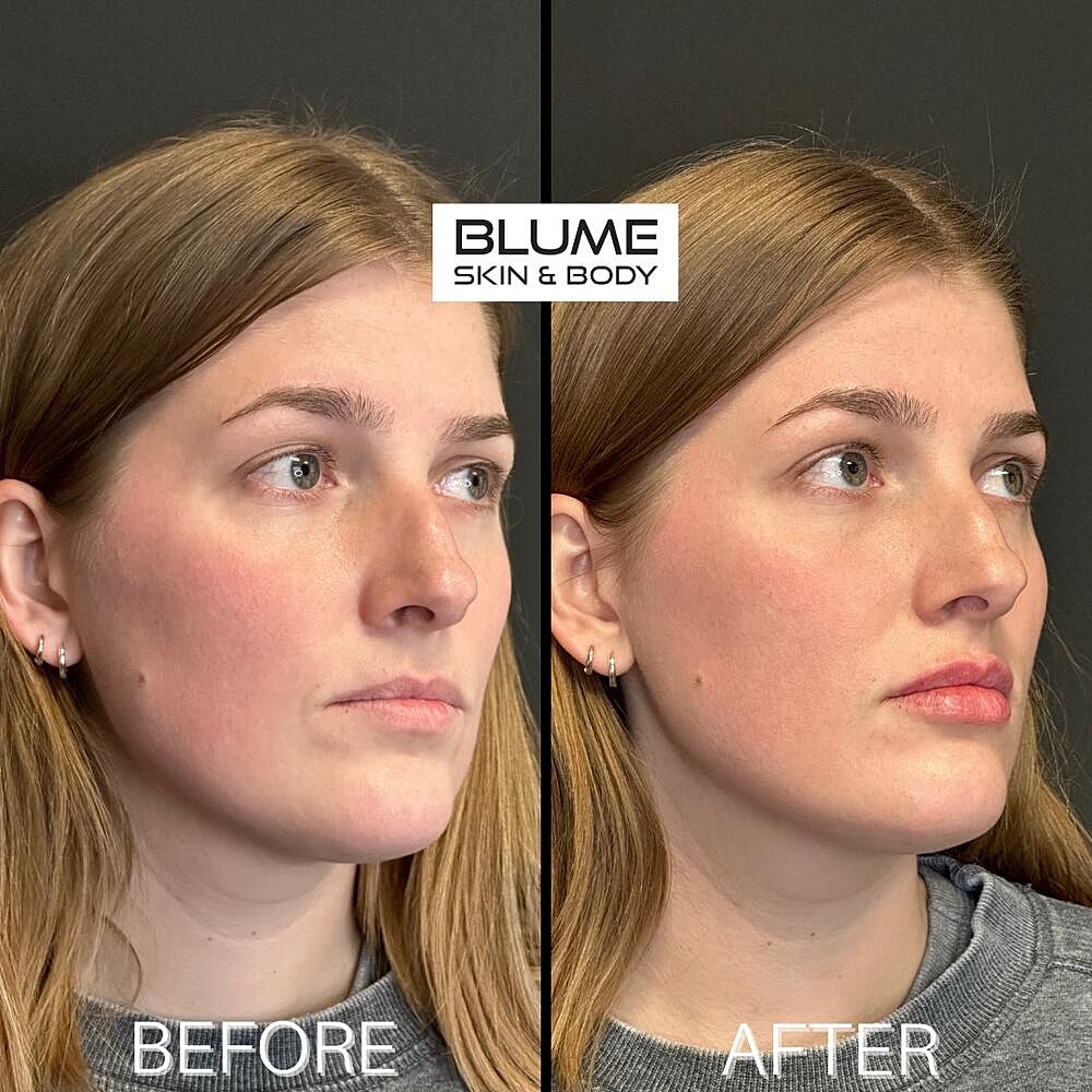 Dermal Fillers Before & After