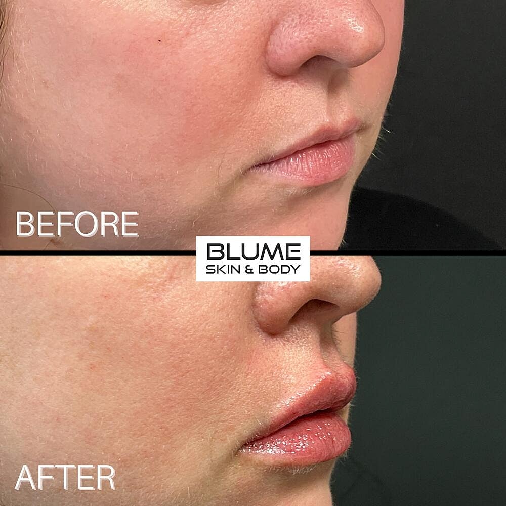 Dermal Fillers Before & After