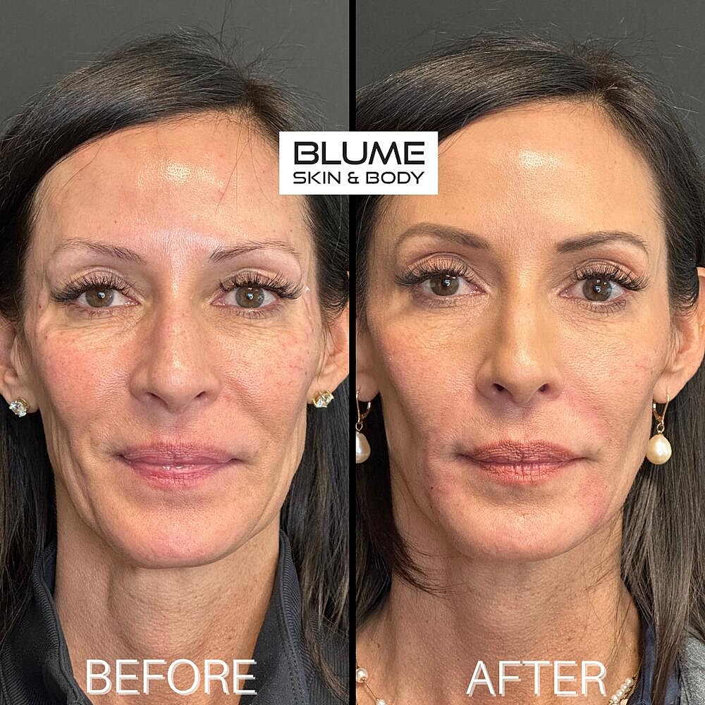 Dermal Fillers Before & After