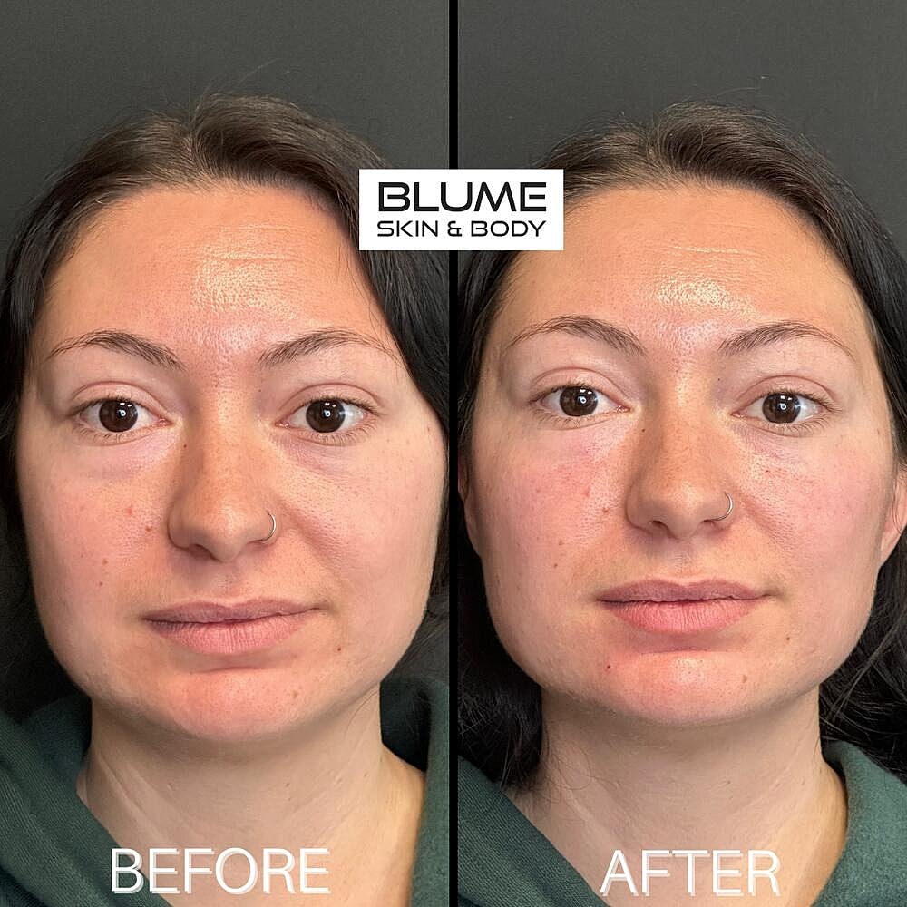 Dermal Fillers Before & After