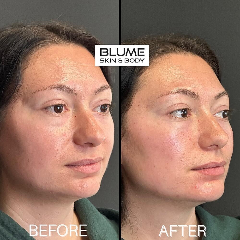 Dermal Fillers Before & After