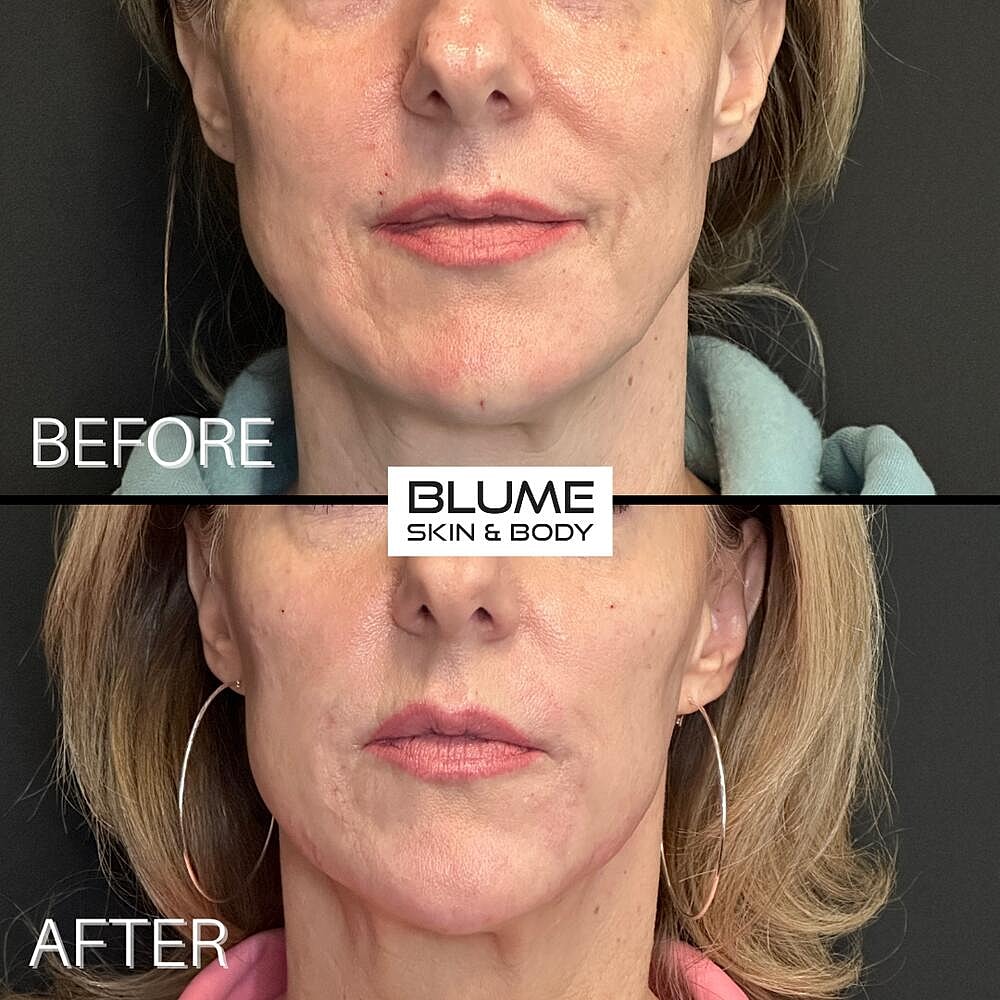 Dermal Fillers Before & After