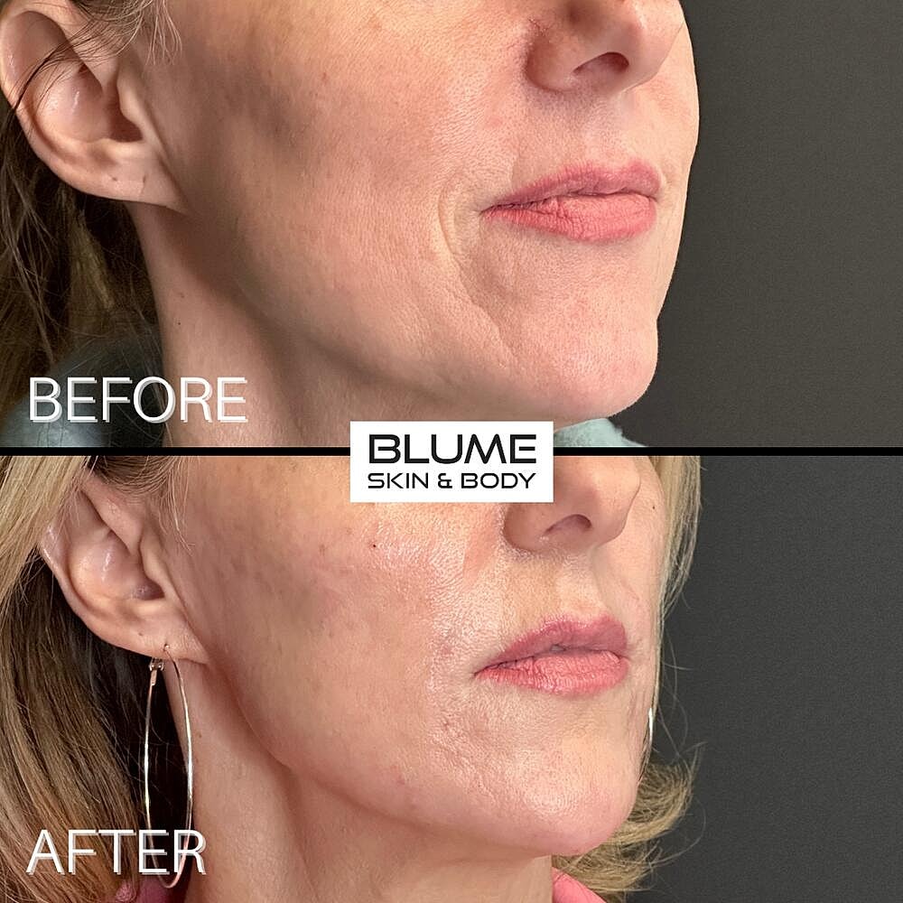 Dermal Fillers Before & After