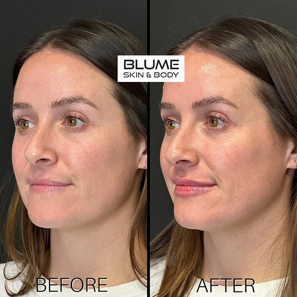 Dermal Fillers Before & After