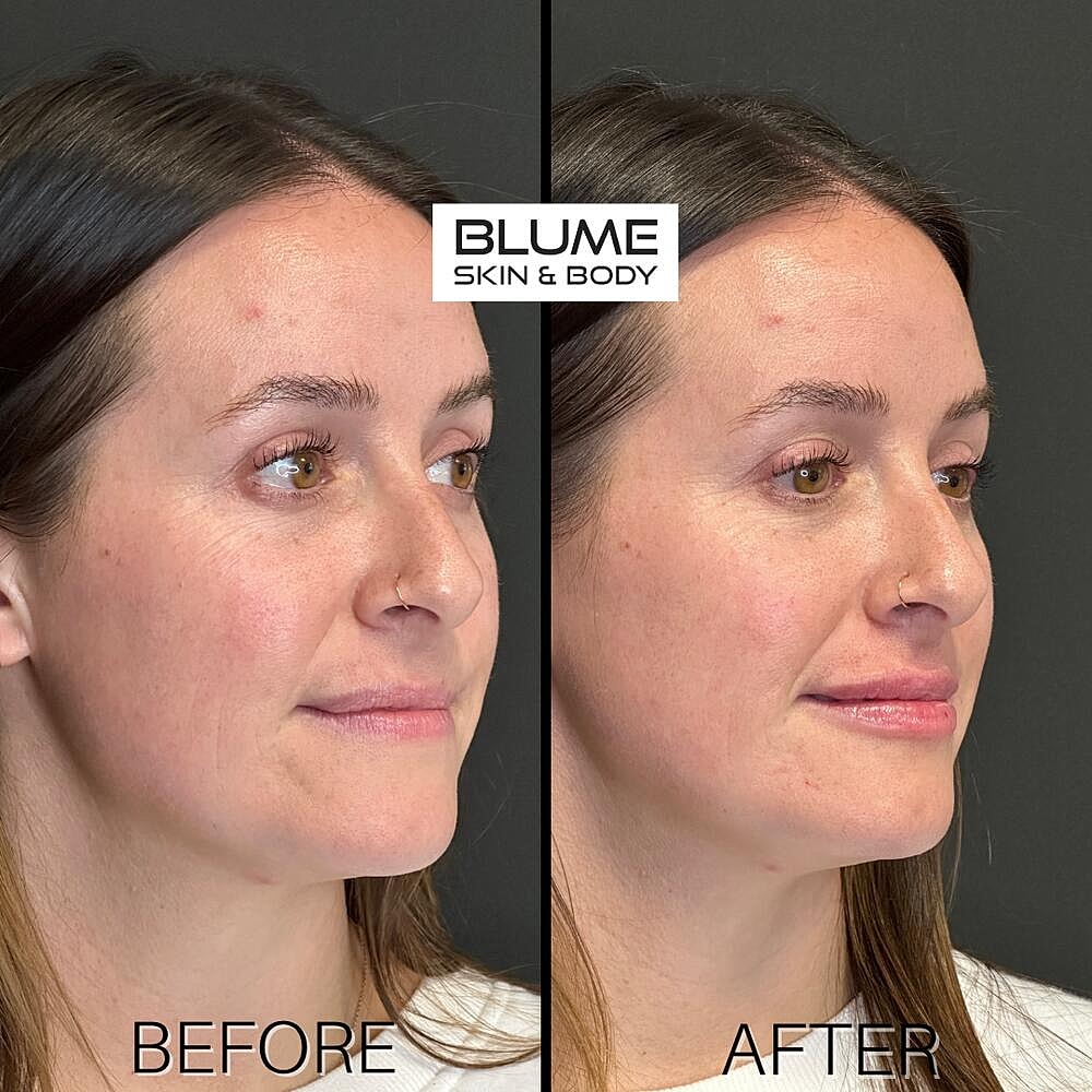 Dermal Fillers Before & After