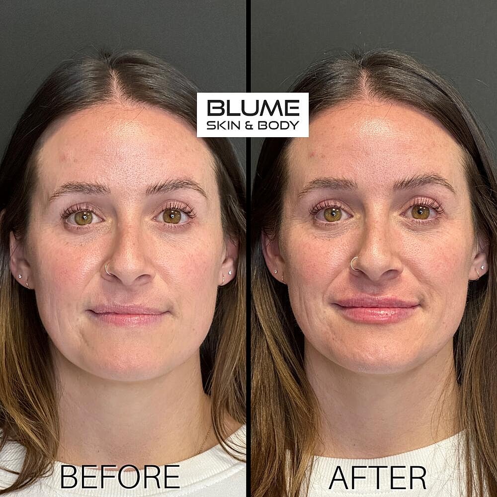 Dermal Fillers Before & After