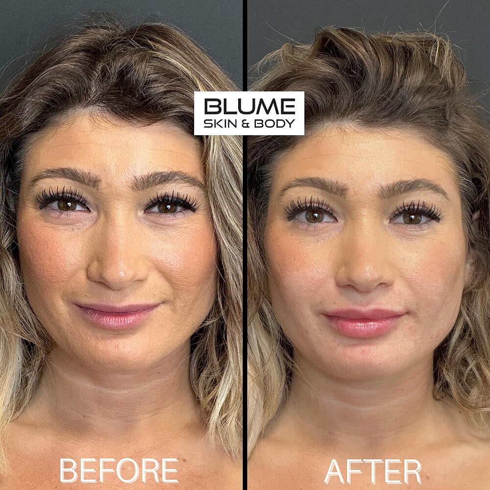 Dermal Fillers Before & After