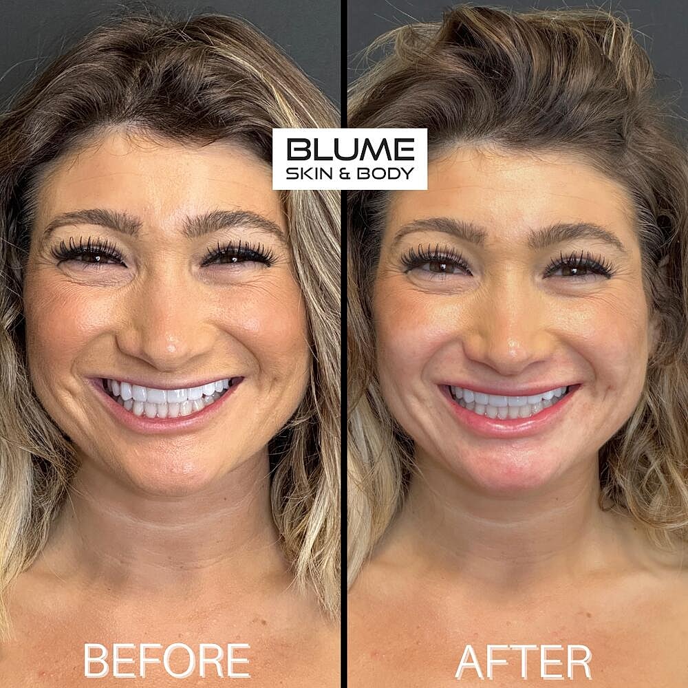 Dermal Fillers Before & After