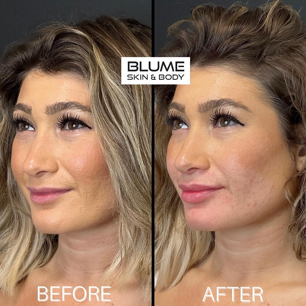 Dermal Fillers Before & After